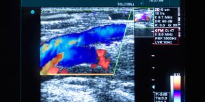 Prrivate deep vein thrombosis ultrasound London