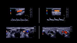 Doppler ultrasound images examining the veins for evidence of DVT