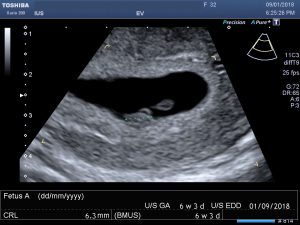 6 week Pregnancy Scan