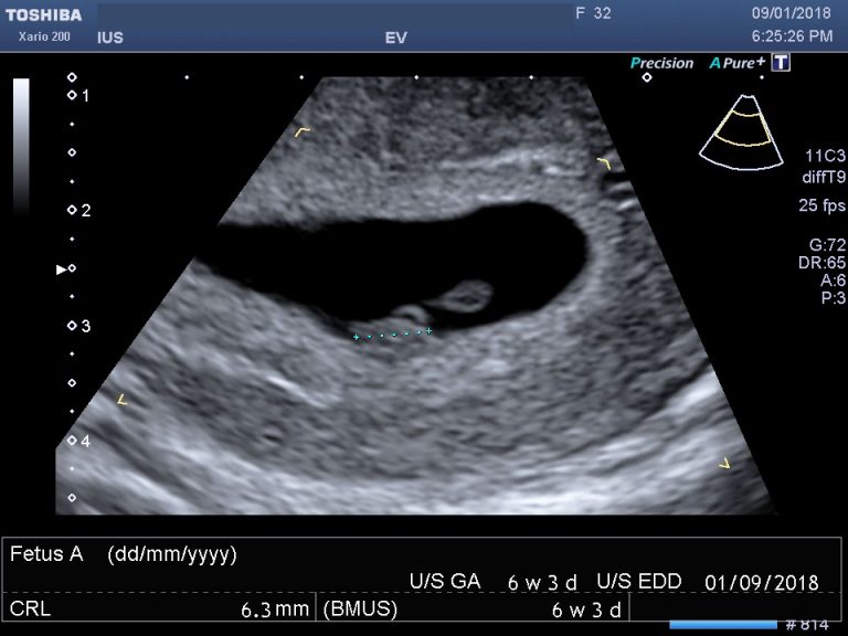 ultrasound image of a 6 week pregnancy scan