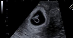 Ultrasound image of a 7 week pregnancy measuring the crown rump length and showing the yolk sca