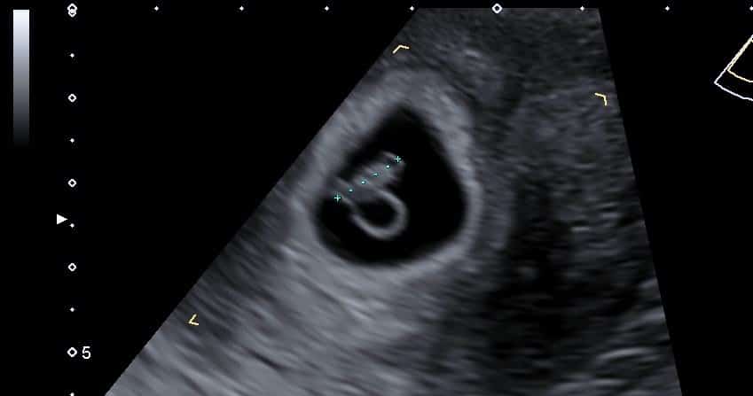 Piscina Giotto Dibondon Ya que 7 week Baby Ultrasound Scan - International Ultrasound Services