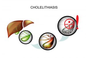 Images of liver and gallbladder stones