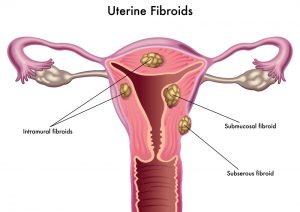 Images showing different types of uterine fibroids