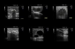 Ultrasound images of cancer