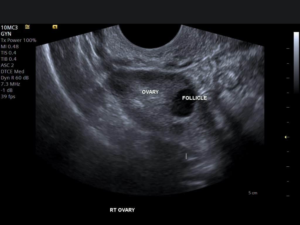 Healthy Ovarian Ultrasound