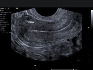 Normal ultrasound image of a uterus