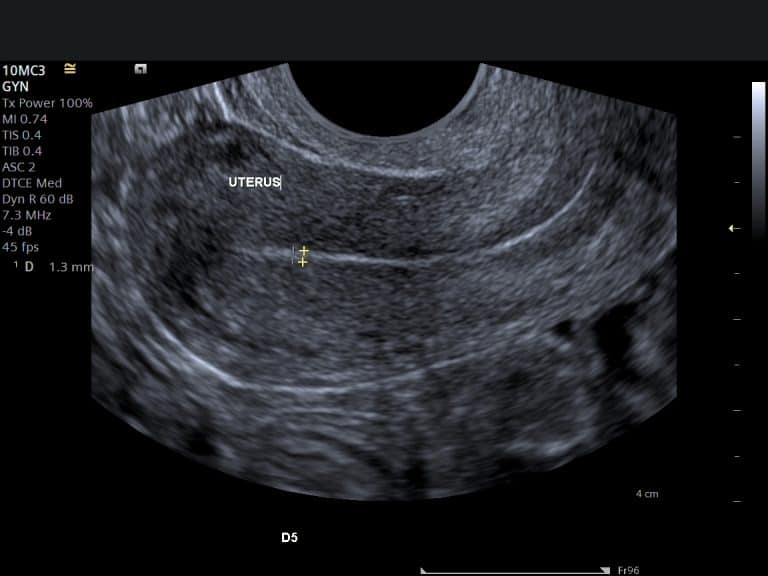 Read more about the article Understanding pelvic ultrasound reports