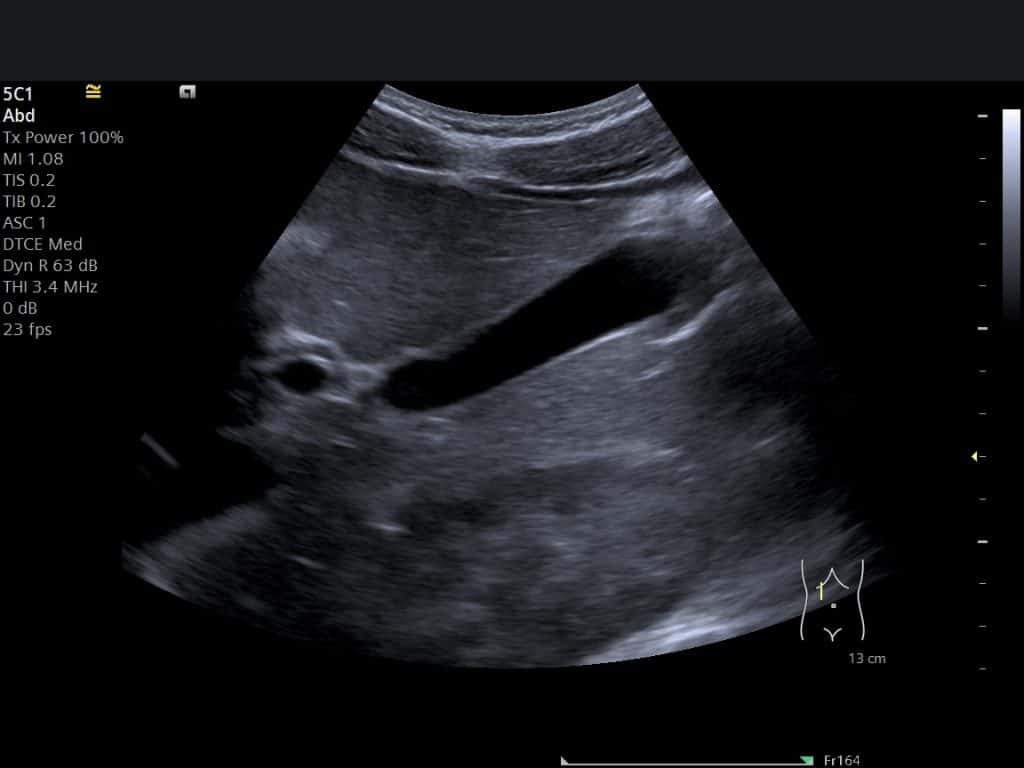 Abdominal ultrasound image showing the liver gallbladder and part of the right kidney
