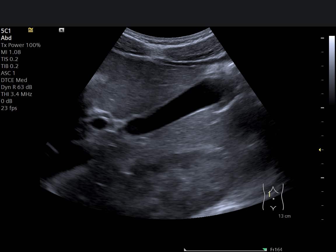 Abdominal ultrasound image showing the liver and gallbladder with normal homogeneous echotexture