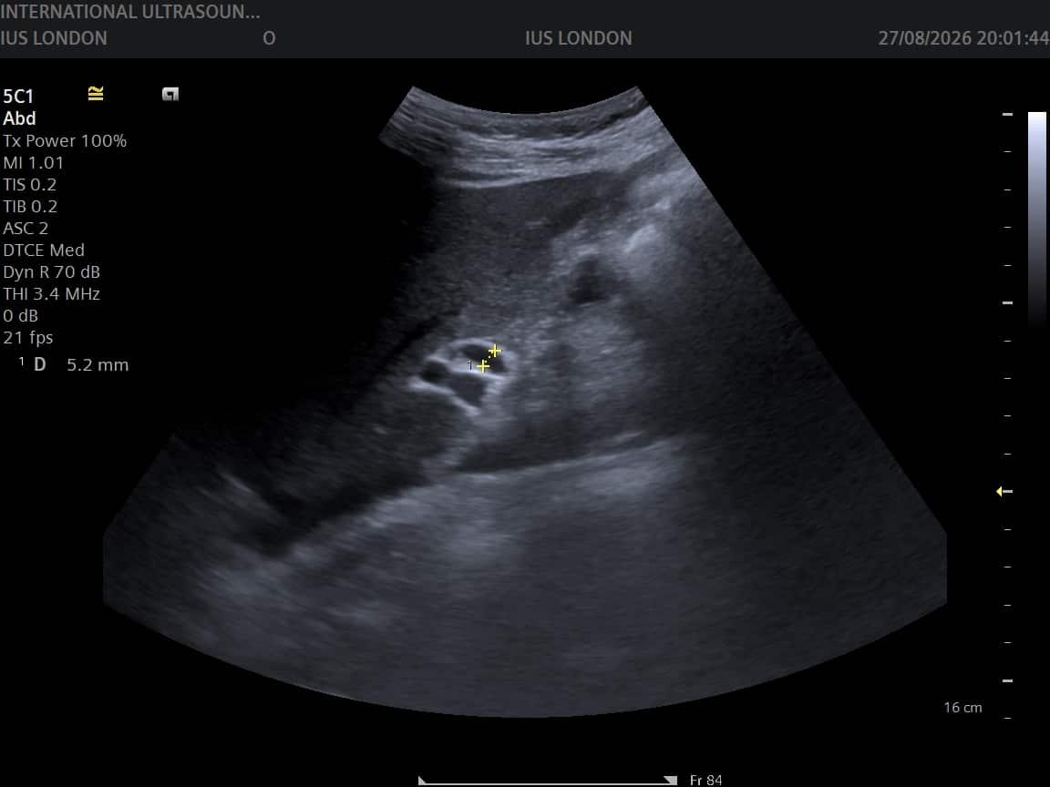 Ultrasound measurement of the common bile duct