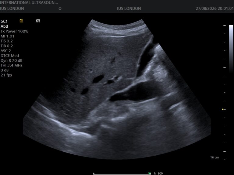 Read more about the article Ultrasound and Cancer Screening — What It Can and Can’t Detect