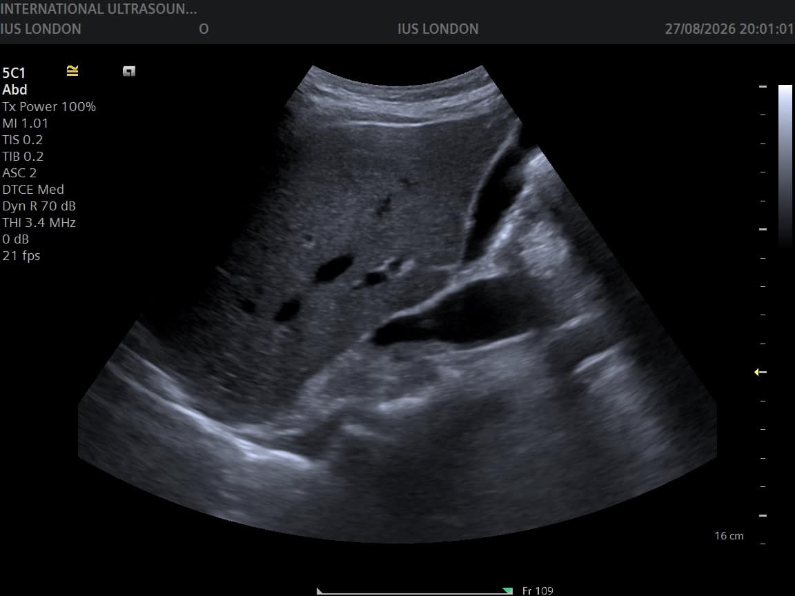 Ultrasound image of the liver and portal vein