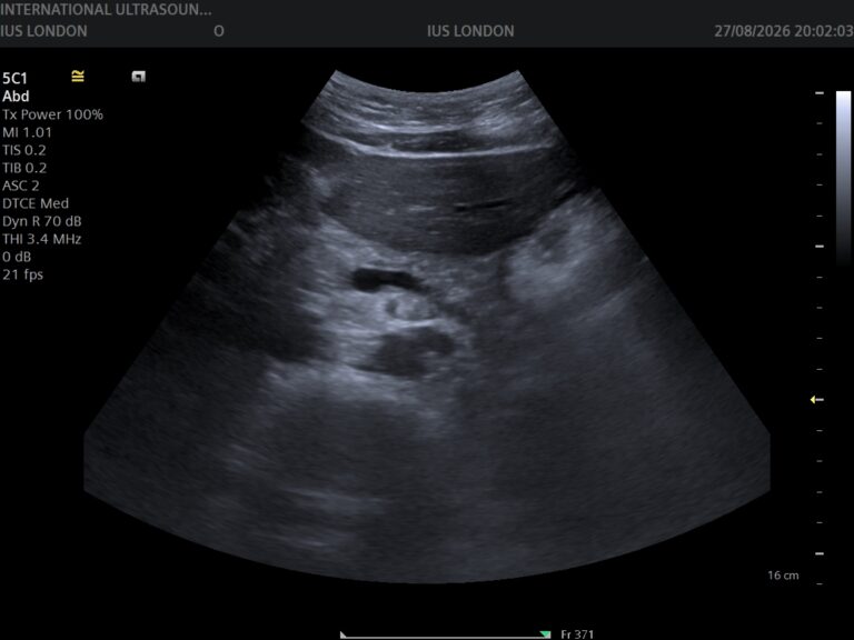 Read more about the article Can You See Cancer in the Abdomen with Ultrasound?