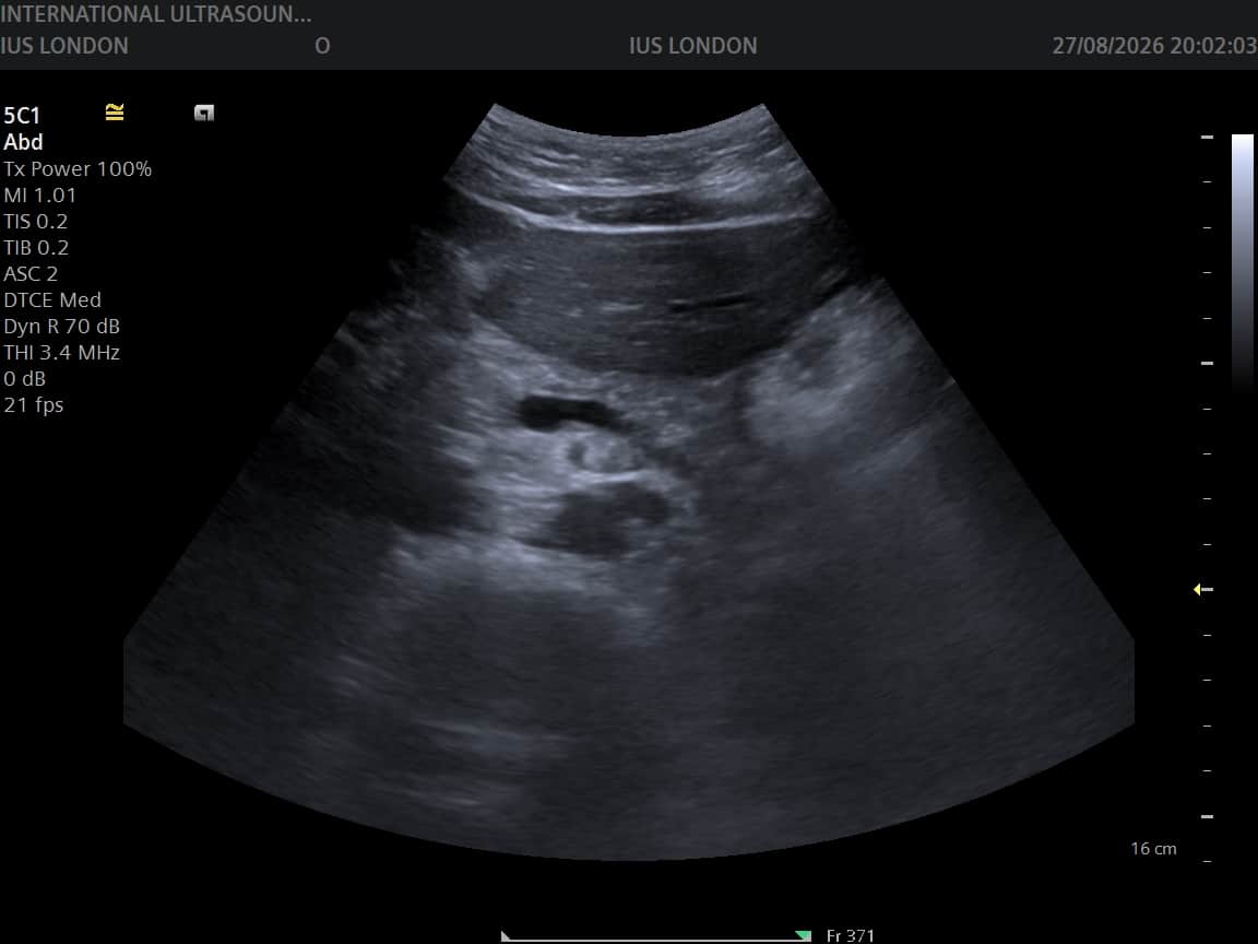 Transverse ultrasound image of the pancreas