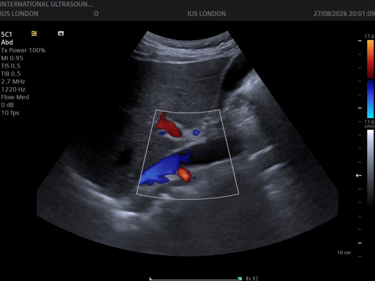 Read more about the article What Do the Red and Blue Colours on an Ultrasound Mean?