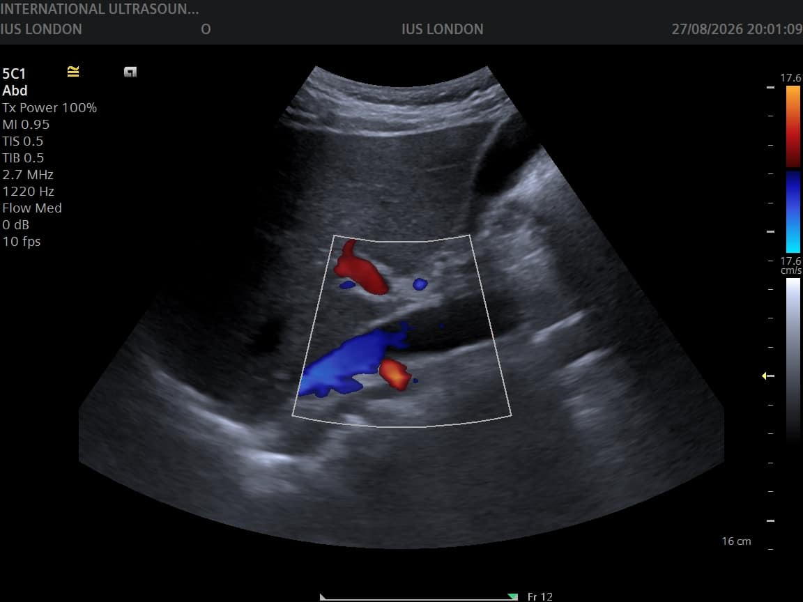 Colour Doppler ultrasound of the porta hepatis
