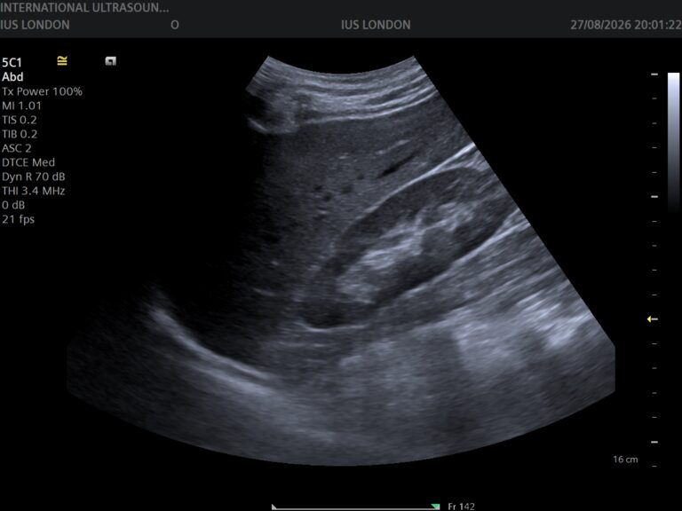 Read more about the article Ultrasound for Common Urologic Conditions