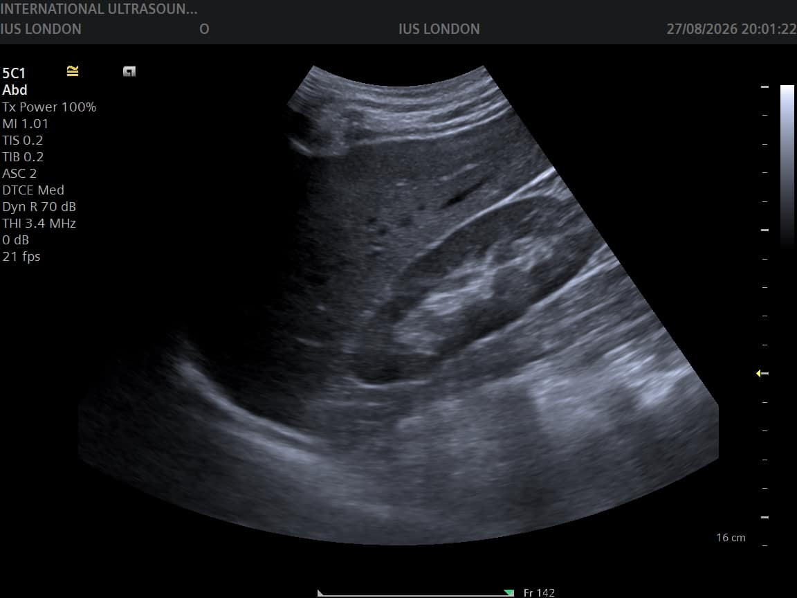Longitudinal ultrasound image of the right kidney