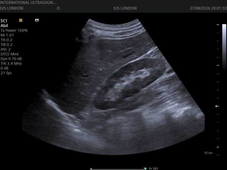 Read more about the article UTIs in Women — and What an Ultrasound Can Actually Show