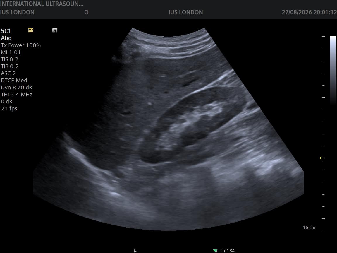 Read more about the article UTIs in Women — and What an Ultrasound Can Actually Show