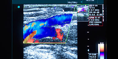 Deep Vein Thrombosis (DVT) Ultrasound Scan